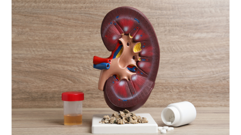 Understanding Kidney Stones: Causes, Risk Factors, Treatment, and Prevention